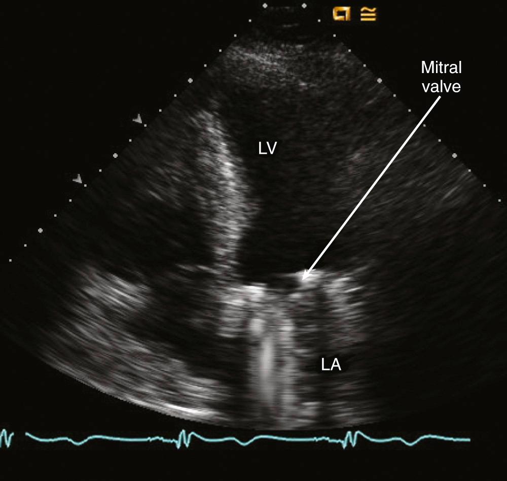 FIGURE 55-3, Apical four-chamber view in a patient with a mechanical mitral valve. Acoustic shadowing distal to the valve obscures visualization of the left atrium (LA). LV, Left ventricle.