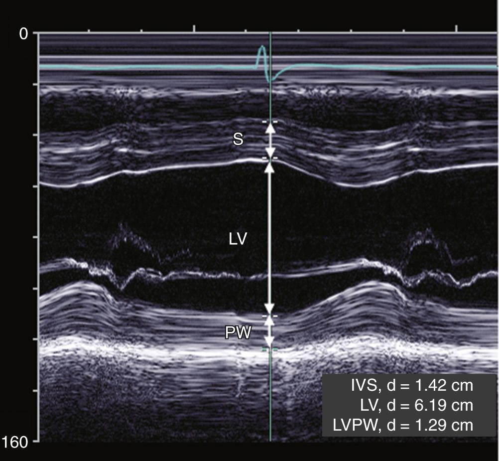 FIGURE 55-4, M-mode tracing from a patient with aortic regurgitation and a dilated left ventricle (LV). LV wall thickness and chamber size are shown throughout the cardiac cycle. Diastolic measurements of the septum (S), LV chamber size, and posterior wall (PW) are shown.