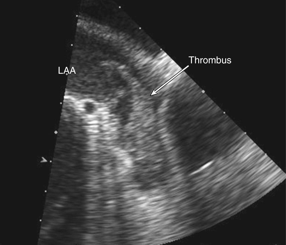 FIGURE 55-5, Imaged using transesophageal echocardiography, an atrial thrombus is seen in the left atrial appendage (arrow) in a patient with atrial fibrillation undergoing evaluation for elective cardioversion. Low-velocity blood flow is evidenced by the spontaneous echo contrast seen at the ostia of the left atrial appendage.