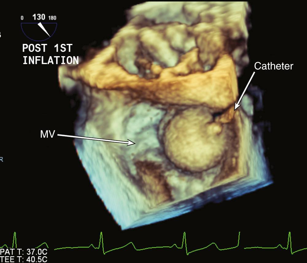 FIGURE 55-6, Three-dimensional transesophageal echocardiography during a mitral valvuloplasty procedure imaged from the atrial side of the valve with a catheter crossing the valve and the valvuloplasty balloon inflated. MV, Mitral valve.