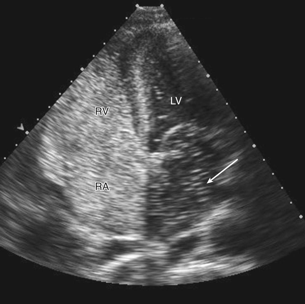 FIGURE 55-7, Opacification of the right atrium (RA) and right ventricle (RV) with intravenous agitated saline contrast. The presence of an interatrial shunt is demonstrated by right-to-left shunting across the septum with bubbles (arrow) in the left atrium and left ventricle (LV) within three cardiac cycles.