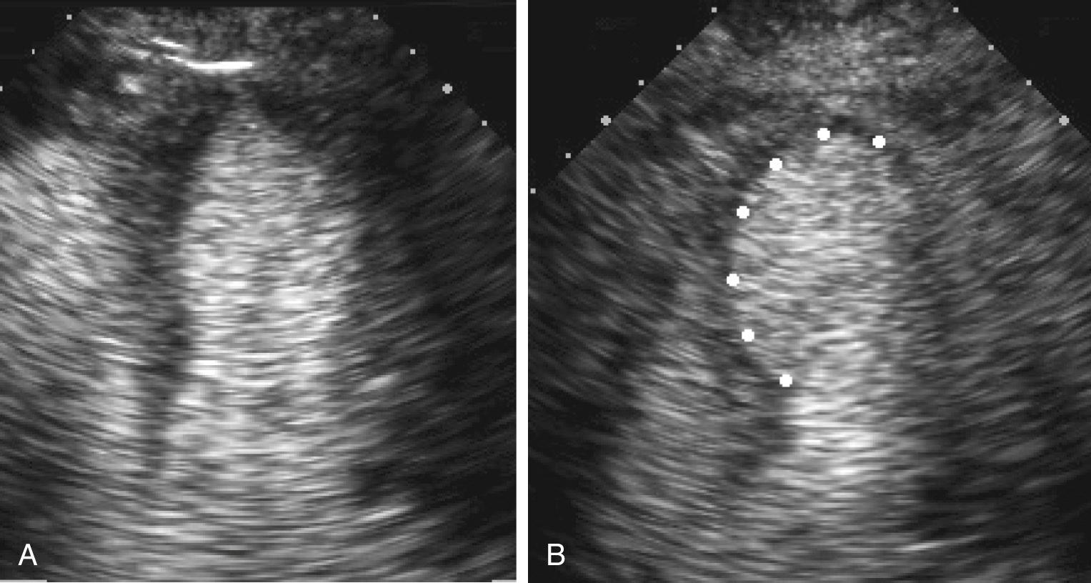 FIGURE 55-8, Abnormal stress echocardiogram with images of the apical four-chamber view taken at rest (A) and following administration of dobutamine (B). Transpulmonary microbubble contrast is used to opacify the left ventricular chamber. After dobutamine administration, there is a wall motion abnormality, with hypokinesis and contour change in the apex and distal septum of the left ventricle (dots) .