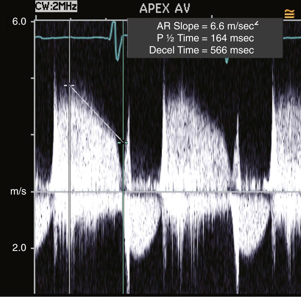 FIGURE 55-9, Spectral Doppler tracing of a patient with severe aortic regurgitation. The Doppler density of regurgitant flow (above the baseline) is nearly equal to anterograde flow (below the baseline). There is a steep aortic regurgitant Doppler slope, suggesting rapid equalization of pressures between the aorta and left ventricle. AR, Aortic regurgitation; Decel, time duration for velocity deceleration; P ½, time duration for pressure gradient to decrease by half.