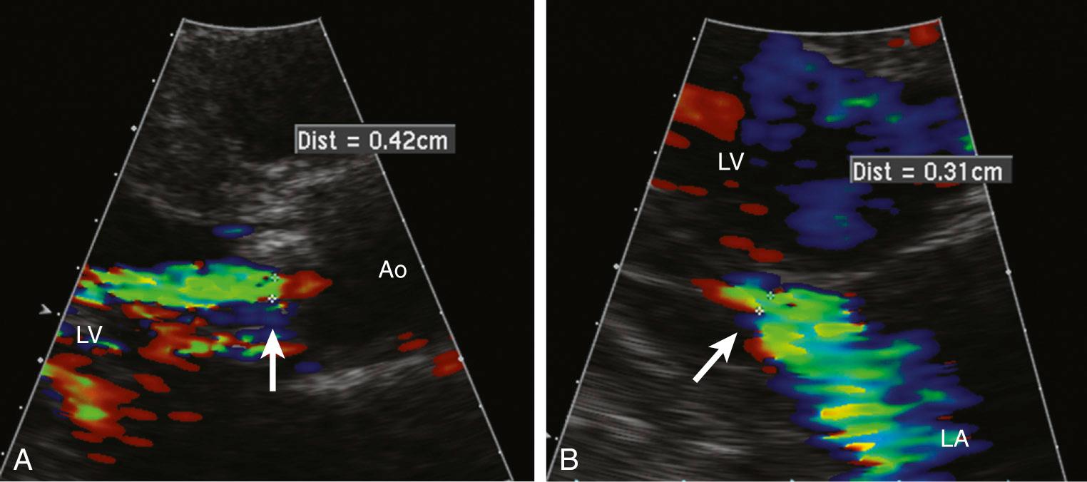 FIGURE 55-10, Vena contracta, the narrowest portion of the jet just distal to the regurgitant orifice for aortic valve (A) and mitral valve (B) regurgitation. Ao, Aorta; LA, left atrium; LV, left ventricle.