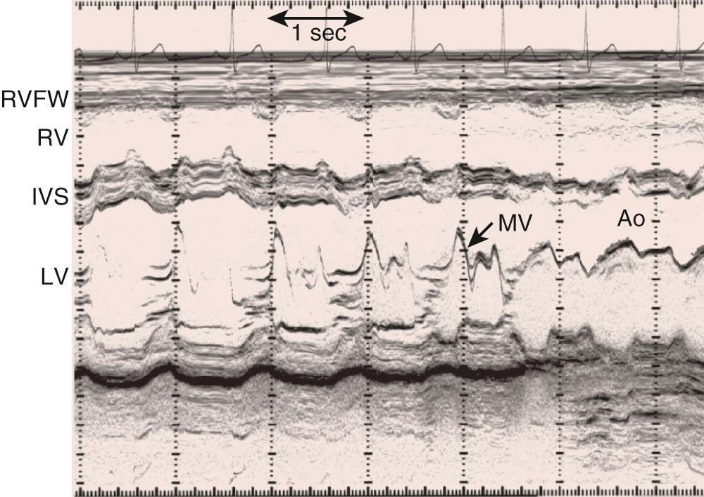 FIGURE 106-1, M-mode tracing of the left ventricle and the aortic root. Ao, Aortic root; IVS, interventricular septum; LV, left ventricle; MV, mitral valve; RV, right ventricle; RVFW, right ventricular free wall.