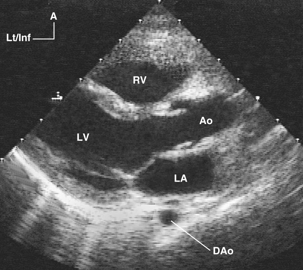 FIGURE 106-2, Two-dimensional image from the parasternal long-axis view showing the left atrium (LA), left ventricle (LV), aortic root (Ao), descending aorta (DAo), and right ventricle (RV).