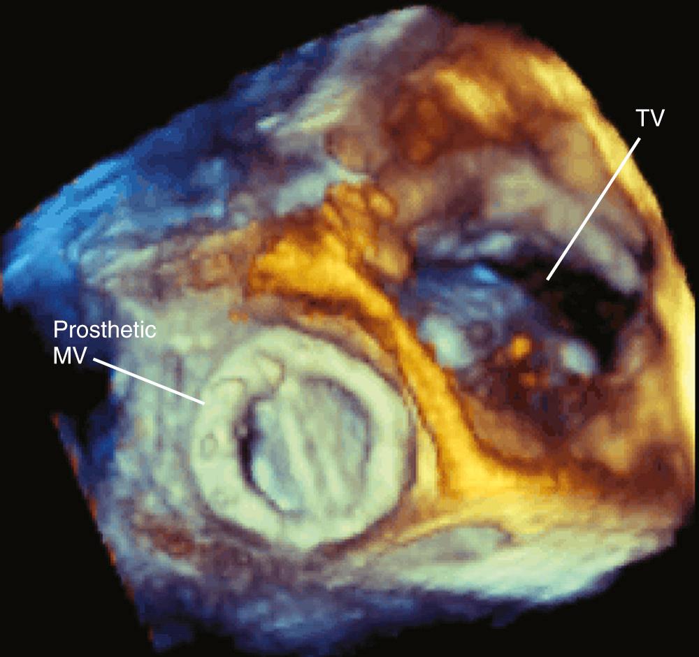 FIGURE 106-3, Three-dimensional echocardiographic imaging of a prosthetic mitral valve (MV) seen from the atria. TV, Tricuspid valve.