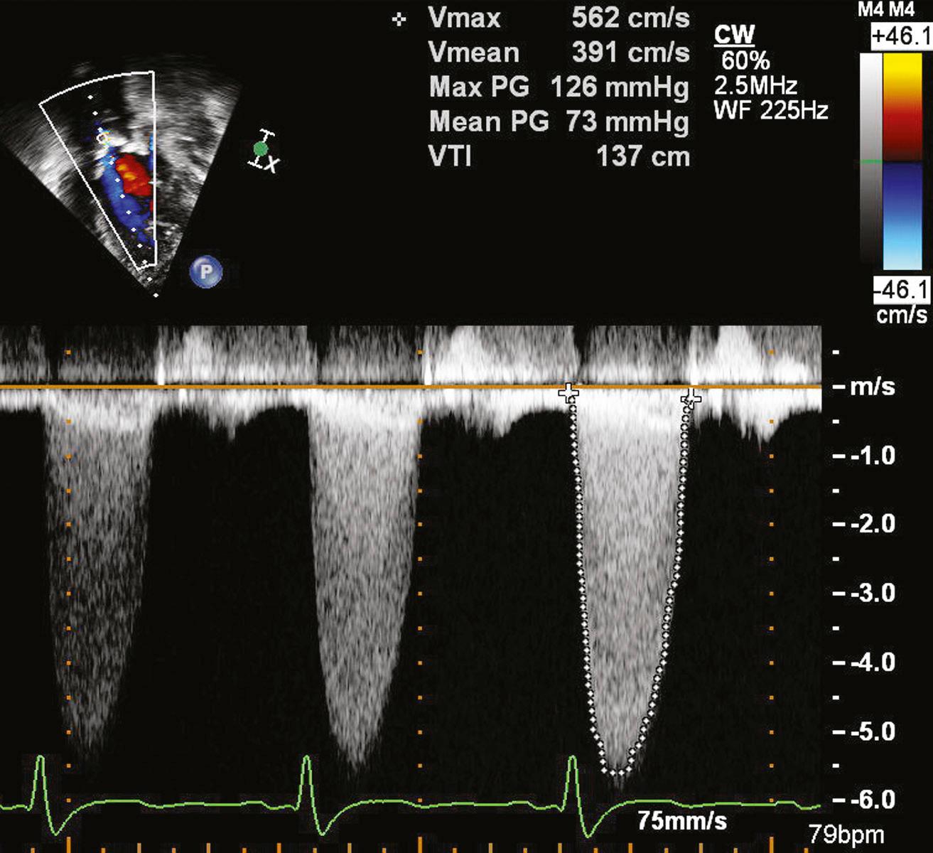 FIGURE 106-4, Doppler echocardiography. Visualization of a high-velocity jet by color Doppler aids in aligning the continuous wave Doppler cursor in a patient with severe aortic valve stenosis (maximal instantaneous and mean gradients ≈126 and 73 mm Hg, respectively).