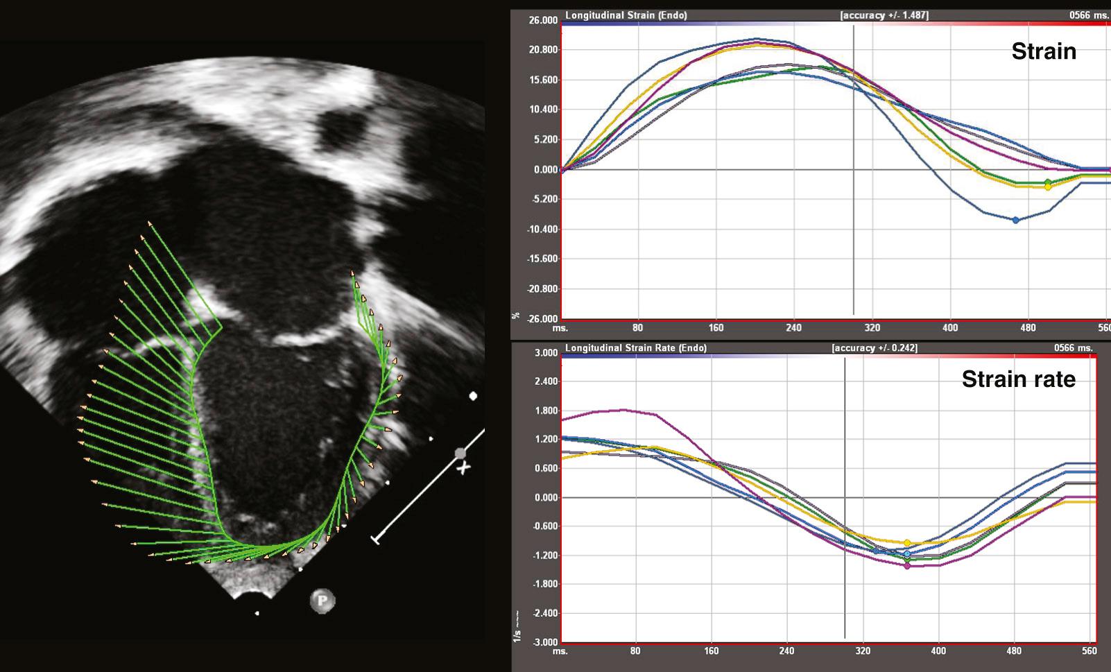 FIGURE 106-5, Speckle-tracking echocardiography. Left panel: Apical four-chamber view with velocity vector mapping of the left ventricle. Right upper panel: Longitudinal strain versus time curves in six segments of the left ventricular wall. Right lower panel: Longitudinal strain rate versus time curves in the same segments.