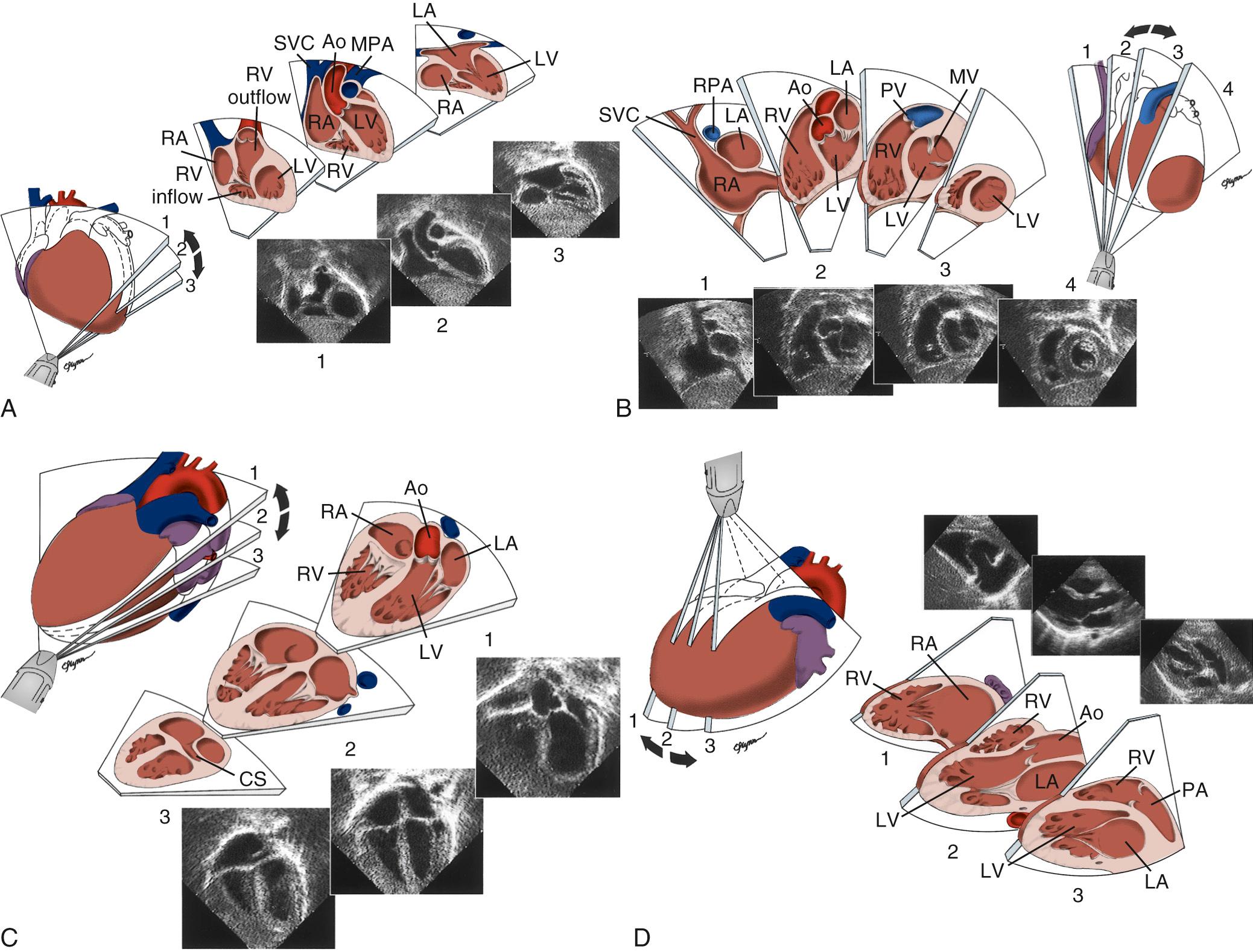 FIGURE 106-6, Standard two-dimensional transthoracic imaging sweeps. A, Subxiphoid long-axis sweep. Slow gradual sweep starting at the level of the upper abdomen will show the connection of the inferior vena cava to the right atrium (RA). The left atrium (LA) is seen next. The connection of the pulmonary veins and the atrial septum can be demonstrated from this view. The left ventricle (LV) is seen along its long axis. Further superior angulation of the transducer depicts the left ventricular outflow tract, aortic valve, and ascending aorta (Ao). The superior vena cava (SVC) is seen to the right of the Ao and the main pulmonary artery (MPA) is seen to the left of the aorta. Further superior tilt of the transducer shows the inflow and outflow of the right ventricle (RV) and the pulmonary valve. The sweep ends with anterior free wall of the right ventricle. B, Subxiphoid short-axis sweep. From the subxiphoid long-axis view, the transducer is rotated clockwise approximately 90 degrees. The sweep begins at the rightward-most aspect of the heart and progresses from right to left through the cardiac apex. The superior vena cava (SVC) and inferior vena cava are seen entering the right atrium (RA). The right pulmonary artery (RPA) is seen in cross-section behind the SVC and above the left atrium (LA). The atrial septum is well seen in this plane. Sweeping the transducer leftward will show the base of the left ventricle (LV) and right ventricle (RV) and the atrioventricular valves. The aortic valve is seen in cross-section at this level. Further leftward tilt of the transducer depicts a cross-sectional view of the LV and mitral valve (MV) as well as the right ventricular outflow tract and pulmonary valve (PV). The sweep ends with imaging of the mid-muscular septum, the papillary muscles, and the apical portions of both ventricles. C, Apical four-chamber sweep. The transducer is positioned over the apex and angled to obtain a cross-sectional view of the atria and ventricles as shown in level 2. The transducer is then angled posteriorly to image the posterior aspect of the heart (level 3). In this plane, the coronary sinus (CS) can be viewed along the posterior left atrioventricular groove. Antero-superior tilt of the transducer will show the left ventricular outflow tract and proximal ascending aorta (Ao). D, Parasternal long-axis sweep. The transducer is placed over the left precordium to the left of the sternum with the index mark toward the patient's right shoulder. A rightward and inferior tilt of the transducer toward the right hip shows the right atrium (RA), tricuspid valve, and right ventricular inflow (RV) (level 1). The coronary sinus can be followed into the right atrium in this view. A leftward and superior tilt of the transducer toward the left shoulder depicts the right ventricular outflow tract (RV), pulmonary valve, and main pulmonary artery (PA) (level 3). E, Parasternal short-axis sweep. From the parasternal long-axis view, the transducer is rotated clockwise approximately 90 degrees. The sweep progresses from a plane that shows the right and left atria (RA and LA), atrial septum, tricuspid valve (TV), right ventricle (RV), pulmonary valve (PV), and main pulmonary artery (level 1) toward the apex. Cross-sectional views of the right ventricle (RV), left ventricle (LV), ventricular septum, mitral valve (MV), and papillary muscles (PMs) are obtained. F, Aortic arch view from the suprasternal notch window. The innominate vein (Innom. Vein) is seen anterior to the innominate artery. The right pulmonary artery (RPA) is seen in cross-section behind the ascending aorta. G, Suprasternal notch view in the transverse plane. The left innominate vein (Innom. V) is seen draining into the superior vena cava (SVC). The distal ascending aorta (Ao) is seen superior to the right pulmonary artery (RPA), which is seen along its length above the left atrium (LA). Note the pulmonary veins entering the left atrium. H, High right parasternal view in the sagittal plane view showing the superior vena cava (SVC) entering the right atrium (RA). This view allows demonstration of the sinus venosus septum. IVC, Inferior vena cava; RUPV, right upper pulmonary vein.