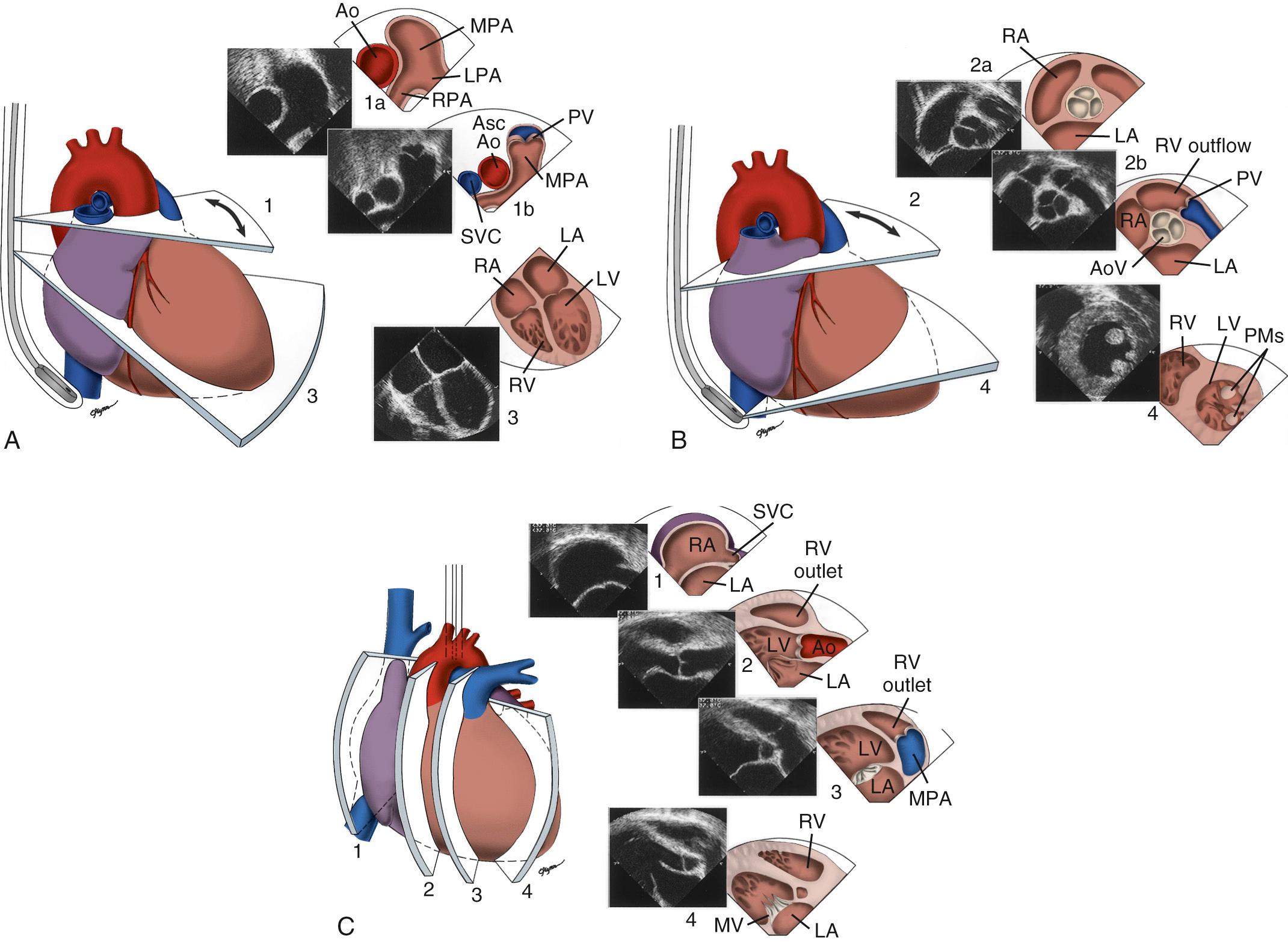 FIGURE 106-7, Transesophageal imaging. A, Transverse plane: cross-sectional view at level 1a depicts the proximal ascending aorta (Ao), main pulmonary artery (MPA), and left and right pulmonary arteries (LPA and RPA, respectively). A rightward tilt of the transducer shows the RPA as it passes behind the superior vena cava (SVC) and ascending aorta (Asc Ao). To obtain a four-chamber view (level 3), the transducer is advanced in the esophagus with slight retroflexion of the scope. B, Level 2 is parallel to the transthoracic parasternal short-axis view. In level 2a, the atrial septum is imaged by a slight rightward tilt of the transducer. In level 2b, the aortic valve (AoV) is seen in cross-section in the center of the image, and the left atrium (LA), right atrium (RA), tricuspid valve, right ventricular outflow (RV outflow), pulmonary valve (PV), and the proximal main pulmonary artery are seen. By advancing the transducer into the lower esophagus and anteflexing the scope, a cross-sectional view of the left ventricle (LV), mitral valve, and papillary muscles (PMs) is obtained (level 4). Note that image orientation is the same as in transthoracic echocardiography. C, Vertical (longitudinal) plane: the sweep begins at a plane that crosses the superior vena cava (SVC), left atrium (LA), right atrium (RA), and atrial septum (level 1). Next, a leftward tilt of the transducer shows an image parallel to the transthoracic parasternal long-axis view of the left atrium (LA), mitral valve, left ventricle (LV), left ventricular outflow tract, and proximal aorta (Ao) (level 2). Further leftward tilt of the transducer (level 3) shows the right ventricular outflow tract (RV outlet), pulmonary valve, and main pulmonary artery (MPA). The sweep continues leftward to show the leftward aspects of the left atrium, mitral valve, and left ventricle (level 4). Further leftward tilt depicts the left atrial appendage and the left pulmonary veins (not shown). Note that image orientation is the same as in transthoracic echocardiography. MV, Mitral valve.