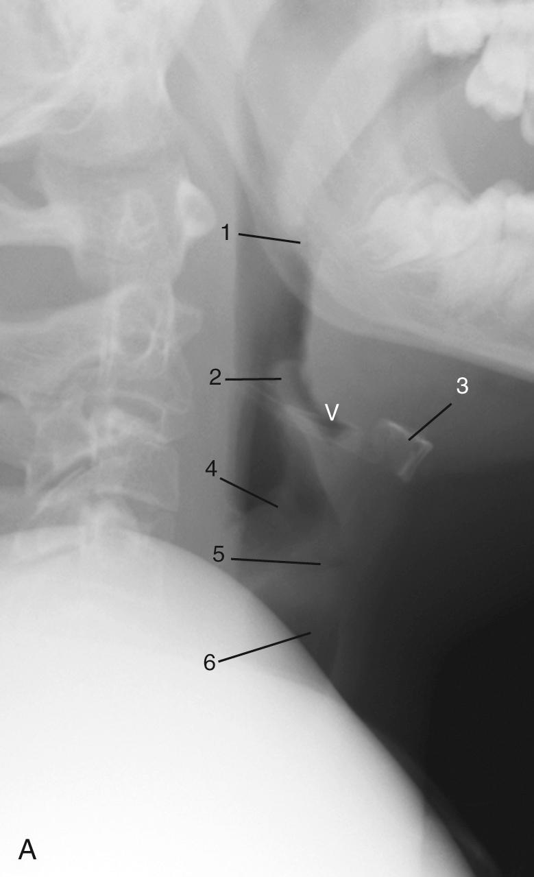 Fig. 104.1, (A and B) A healthy upper airway in a 14-year-old patient. The following structures are well visualized: palatine tonsil (1) , epiglottis (2) , body of the hyoid bone (3) , aryepiglottic folds (4) , laryngeal ventricle (5) , subglottic airway (6) , vallecula (V) , and piriform sinus (P) .