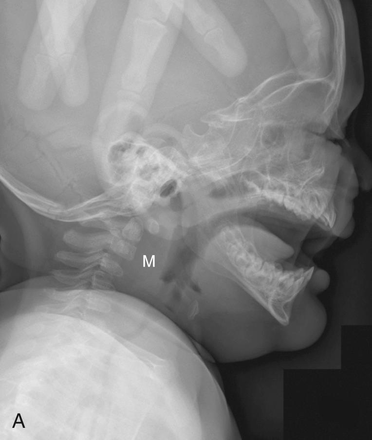 Fig. 104.2, Pseudoretropharyngeal mass.