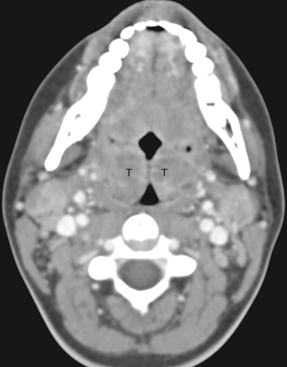 Fig. 104.3, Tonsillitis.