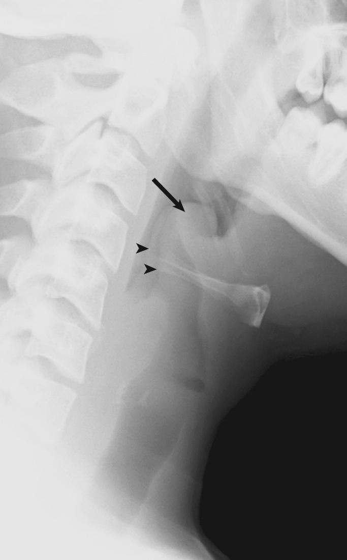 Fig. 104.4, Epiglottitis.