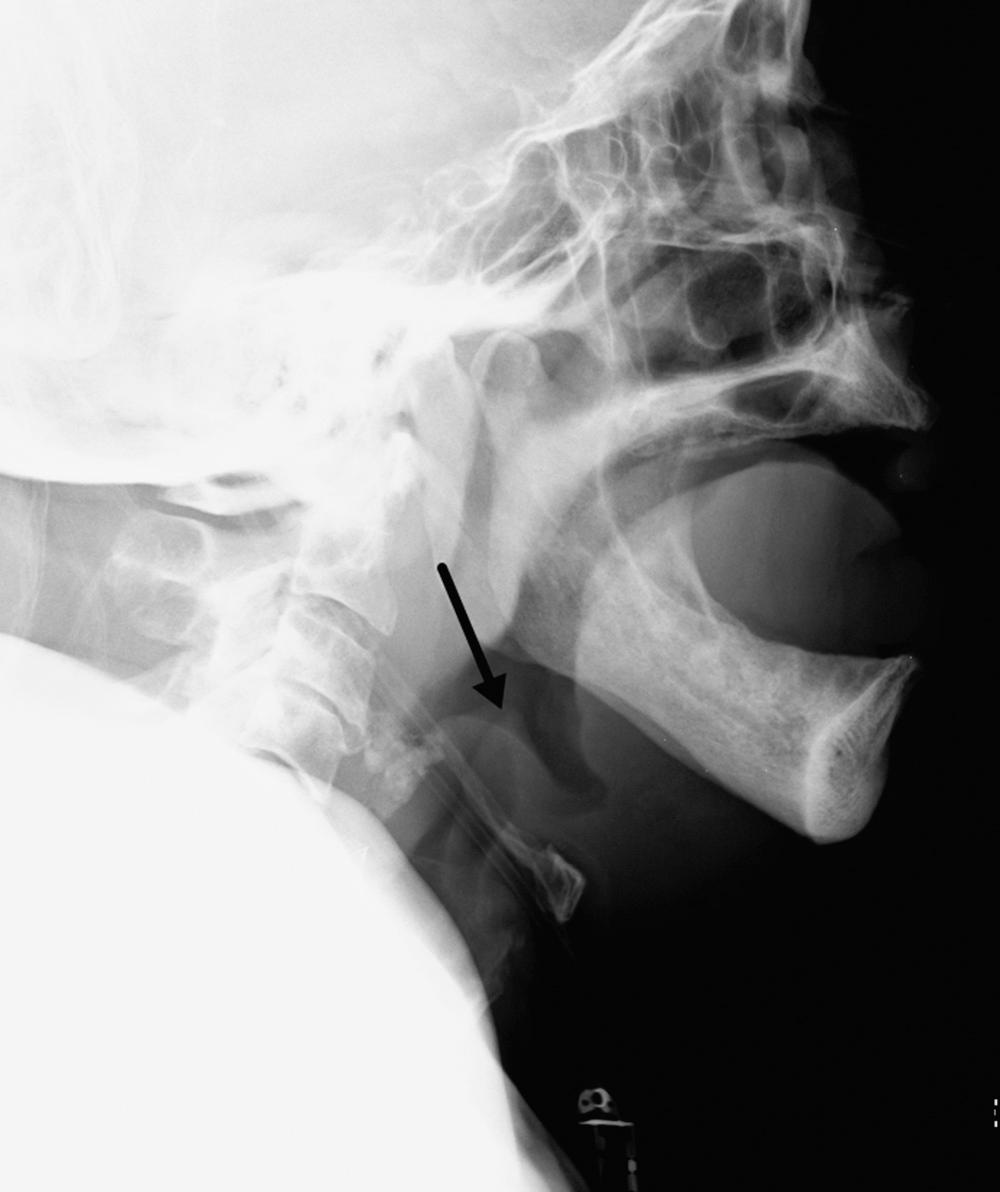 Fig. 104.5, Epiglottic angioedema.