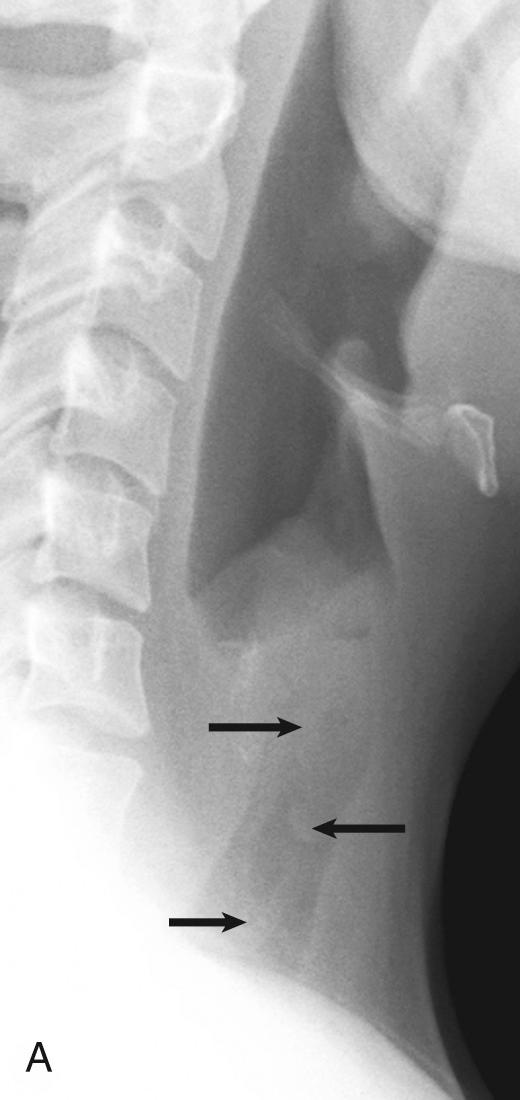 Fig. 104.7, Membranous croup.