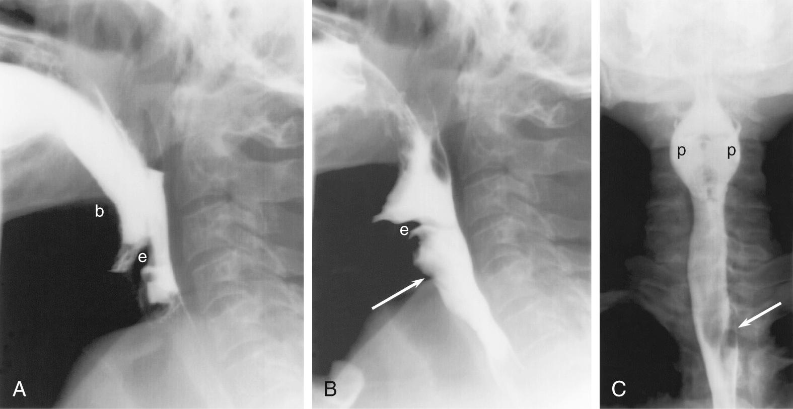 Fig. 100.2, Normal pharyngogram.