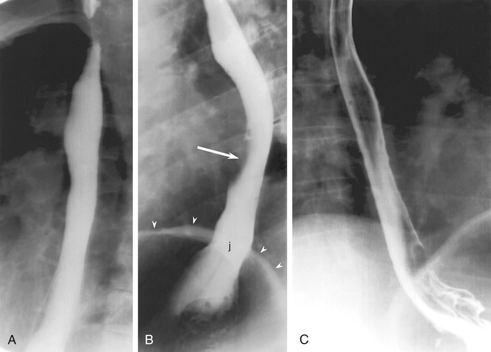 Fig. 100.3, Normal esophagogram.