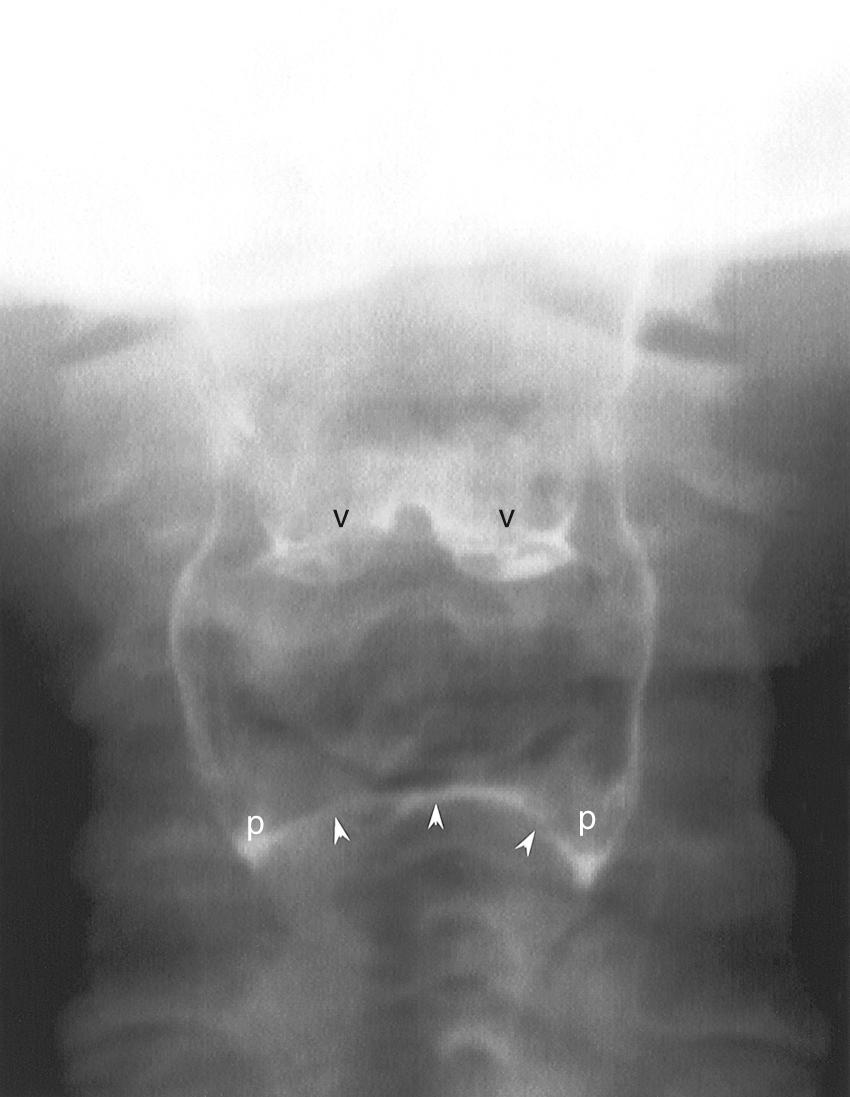 Fig. 100.4, Normal air-contrast pharyngogram, frontal projection.