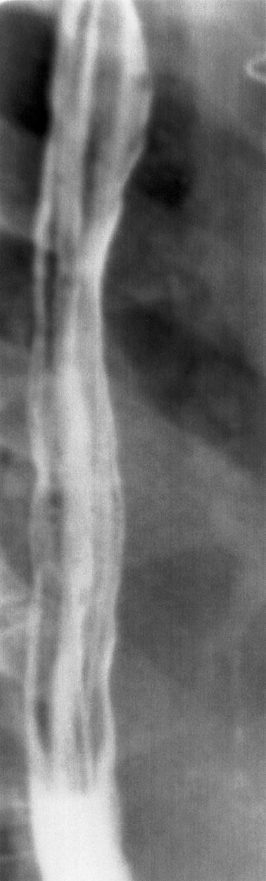 Fig. 100.5, Normal mucosal-relief esophagogram, oblique projection.