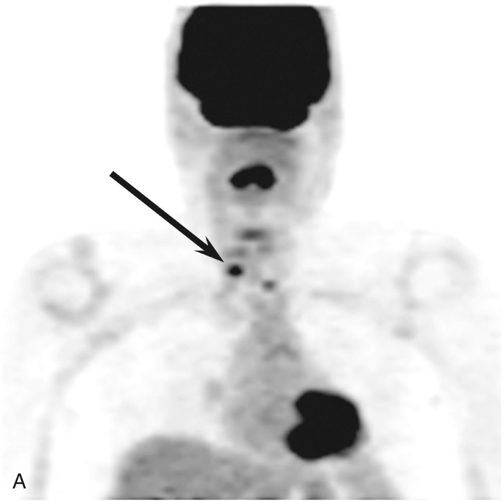 Fig. 100.6, Localization with positron emission tomography–computed tomography (PET-CT).