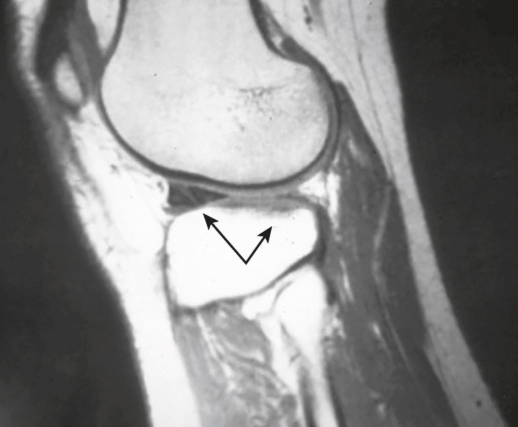 eFig. F.1, Absent Bow-Tie Sign.