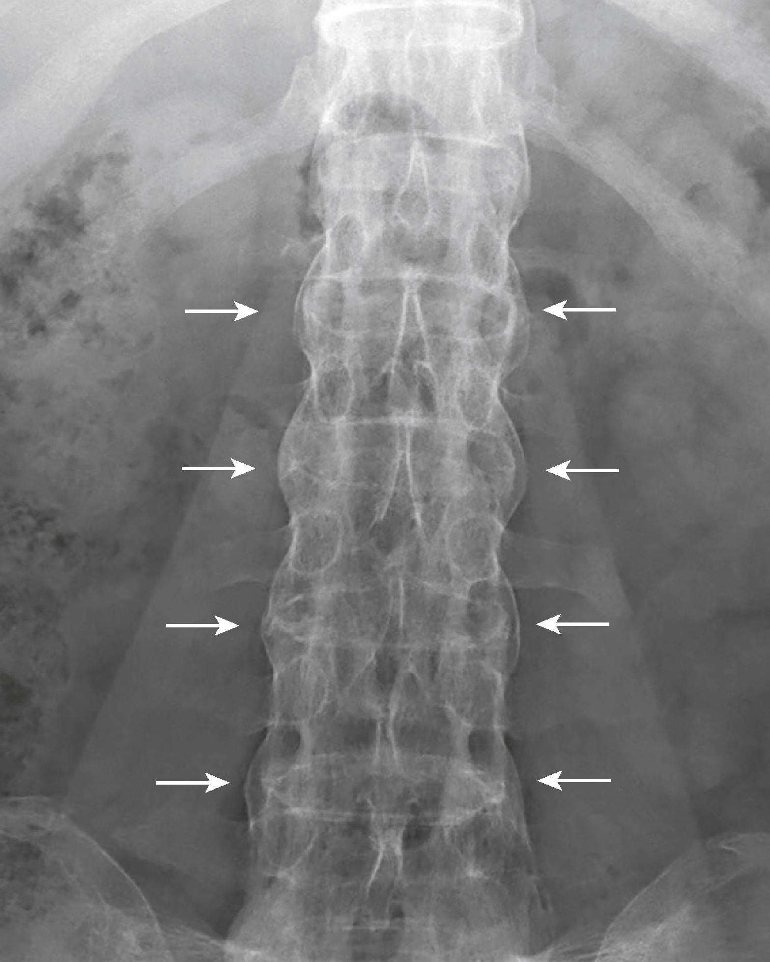 eFig. F.11, Bamboo Spine.