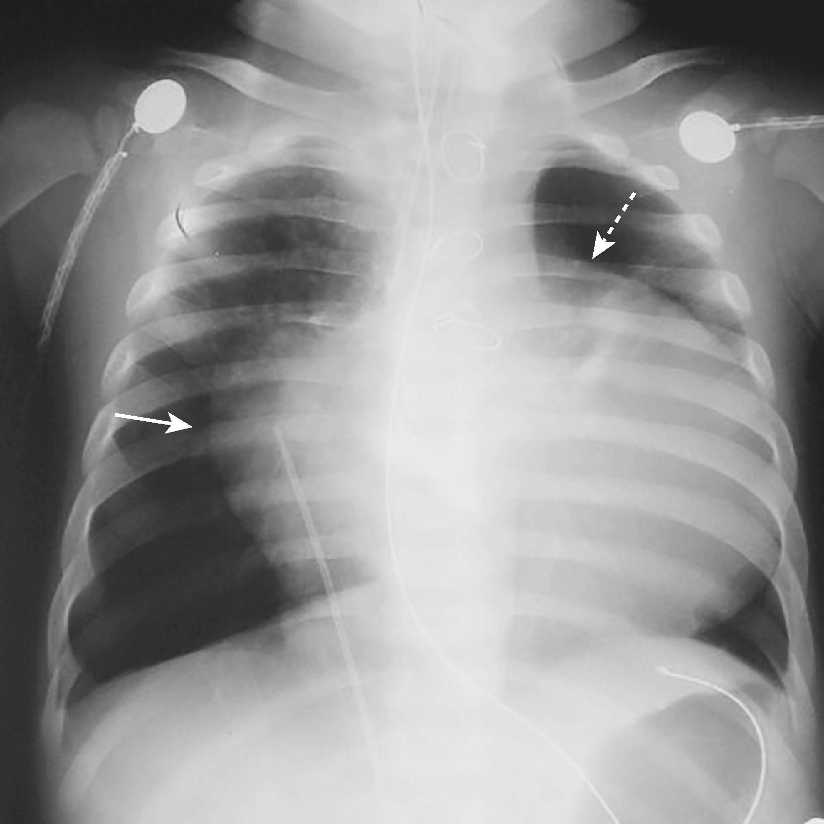 eFig. F.26, Box-shaped Heart.