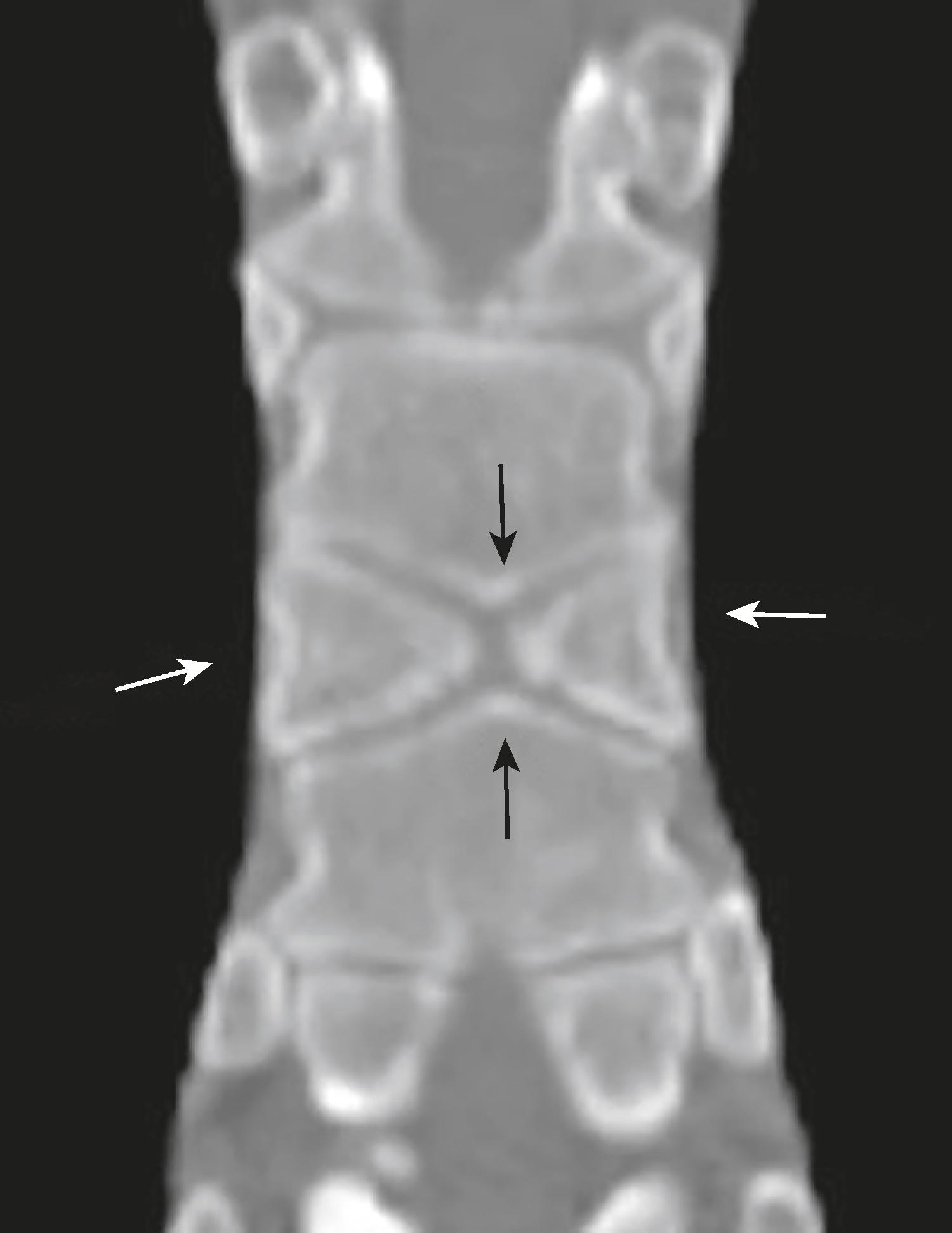 eFig. F.28, Butterfly Vertebra.