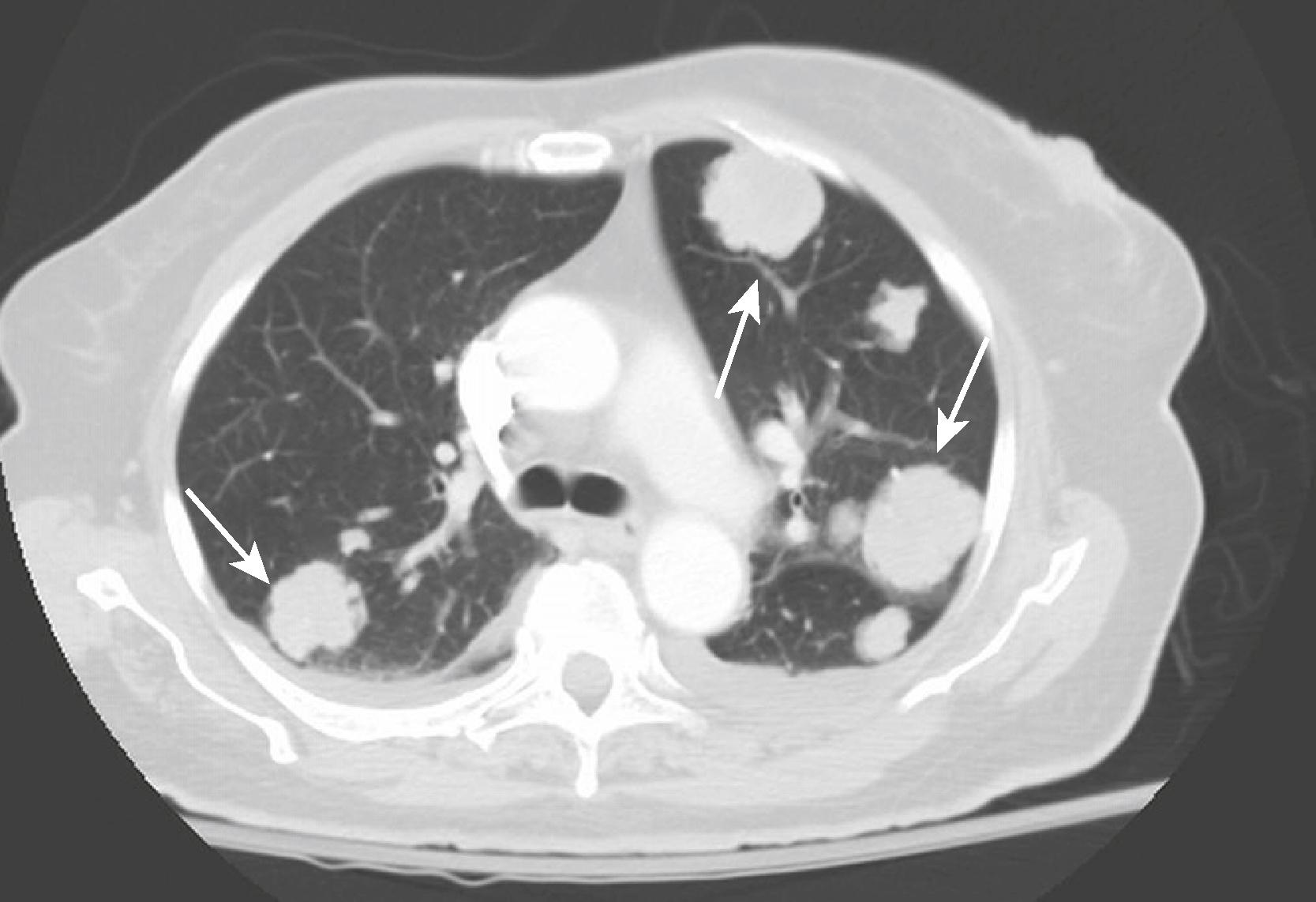 eFig. F.30, Cannonball Metastases.