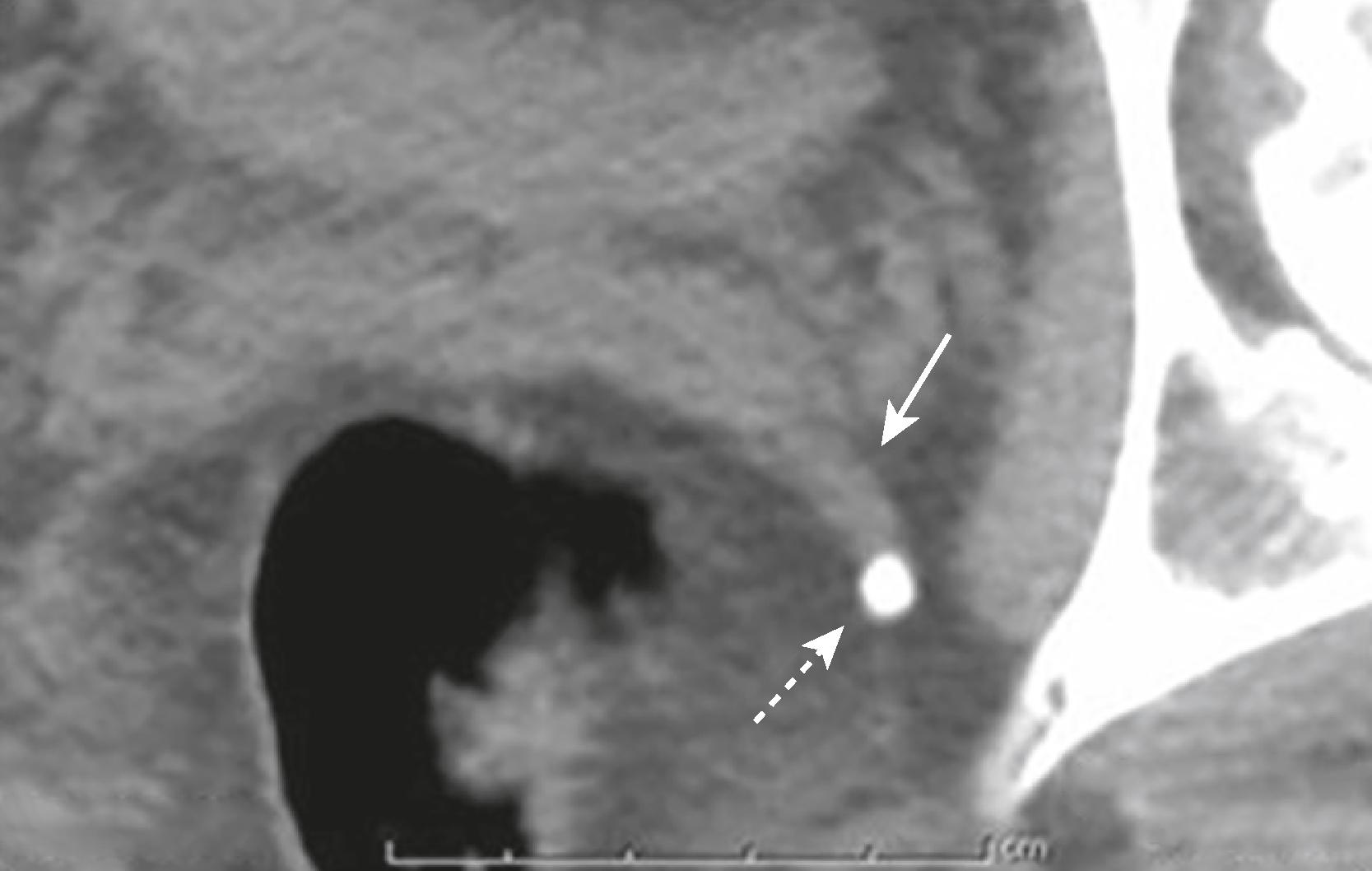 eFig. F.44, Comet Tail Sign (Phlebolith).