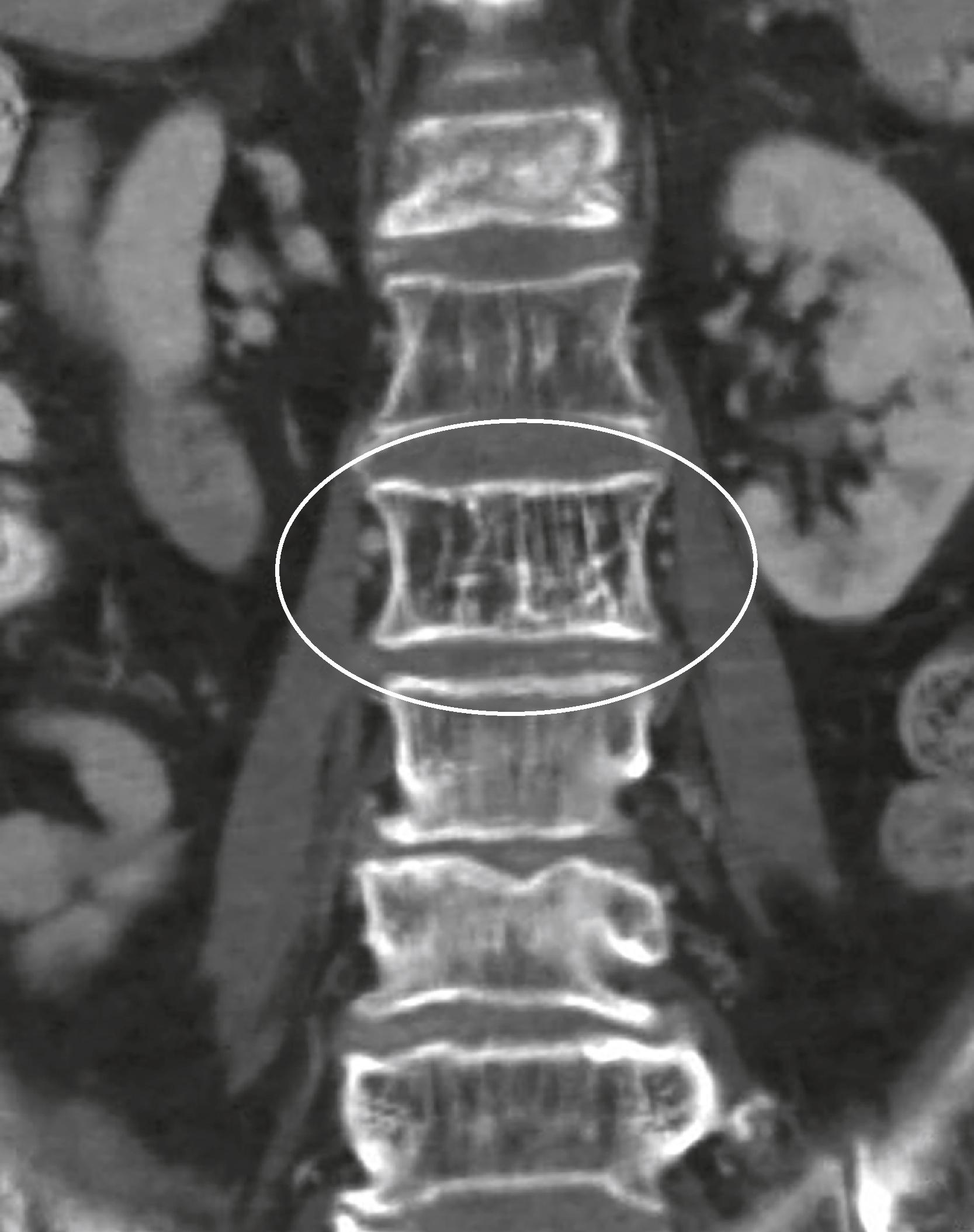 eFig. F.46, Corduroy Vertebra.