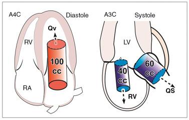 Fig. 15.12, Quantitative Doppler Technique to Assess Mitral Regurgitation Severity.