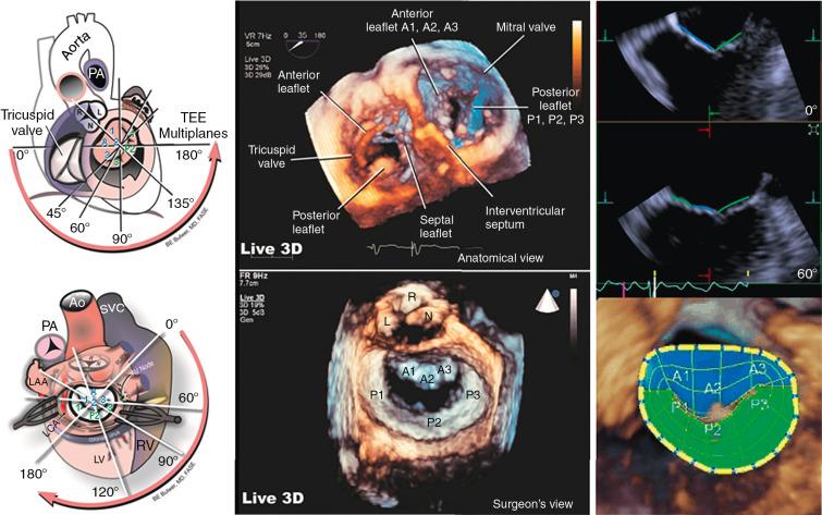 Fig. 15.14, Anatomy of the Mitral Valve From Transesophageal Echocardiography.