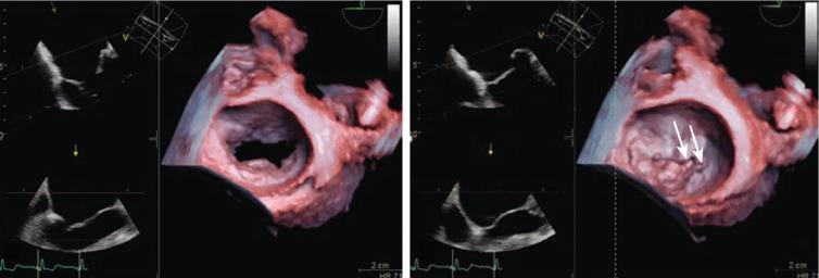 Fig. 15.15, Flail Mitral Chords on Three-Dimensional Echocardiography.