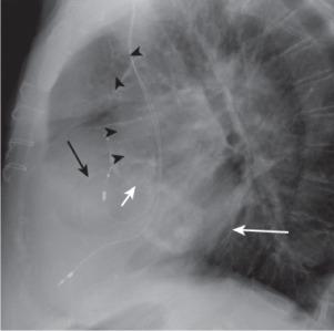 Fig. 15.4, Calcification of the Heart.