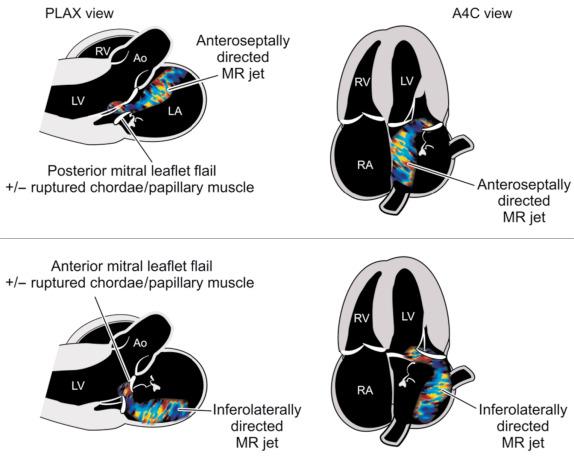 Fig. 15.5, Acute Mitral Regurgitation.