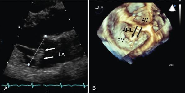 Fig. 15.6, Degenerative Mitral Regurgitation.