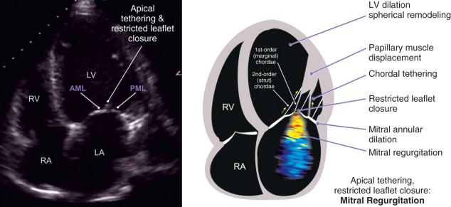 Fig. 15.8, Mechanisms of Secondary Mitral Regurgitation.