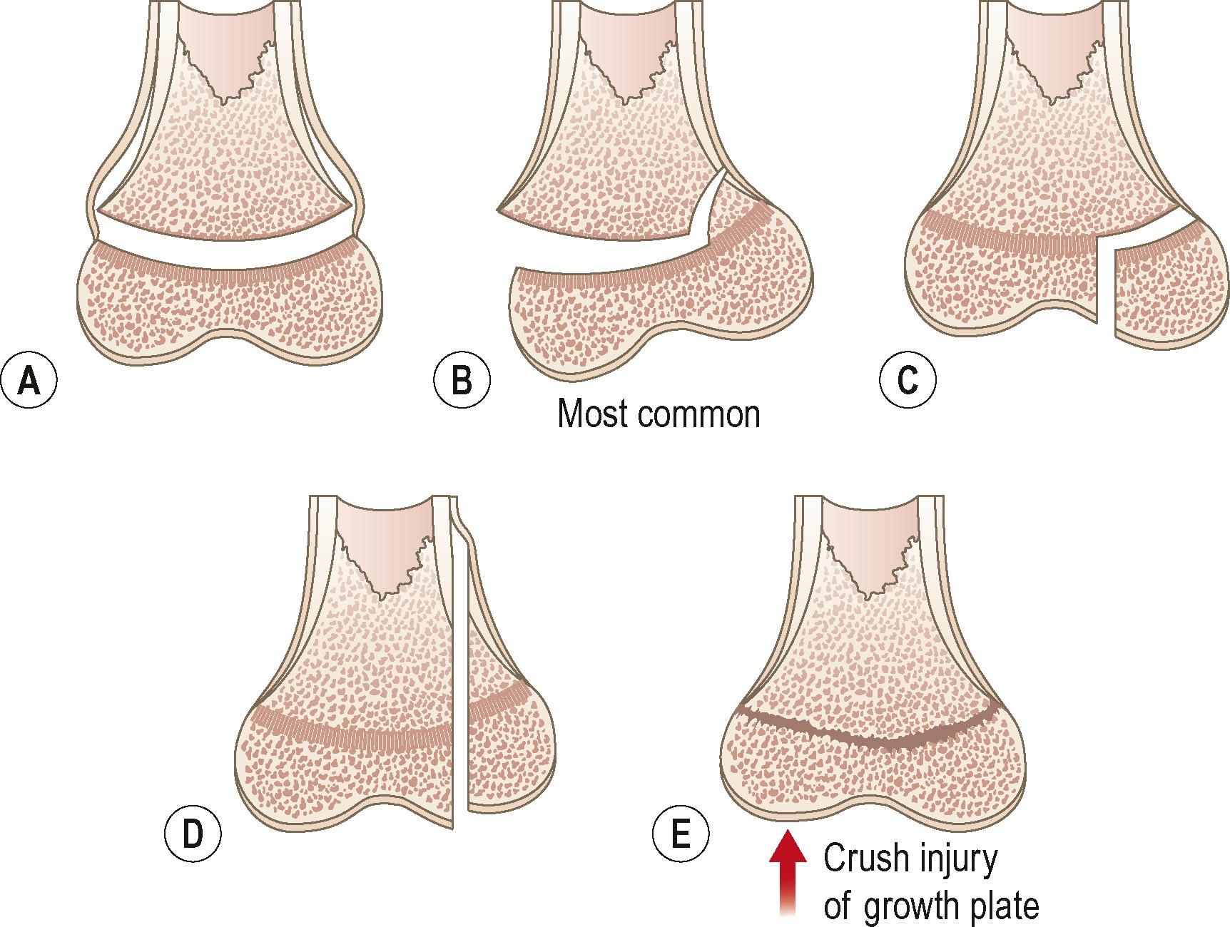 Figure 3.12, (A–E) The Salter–Harris classification of epiphyseal plate injuries.