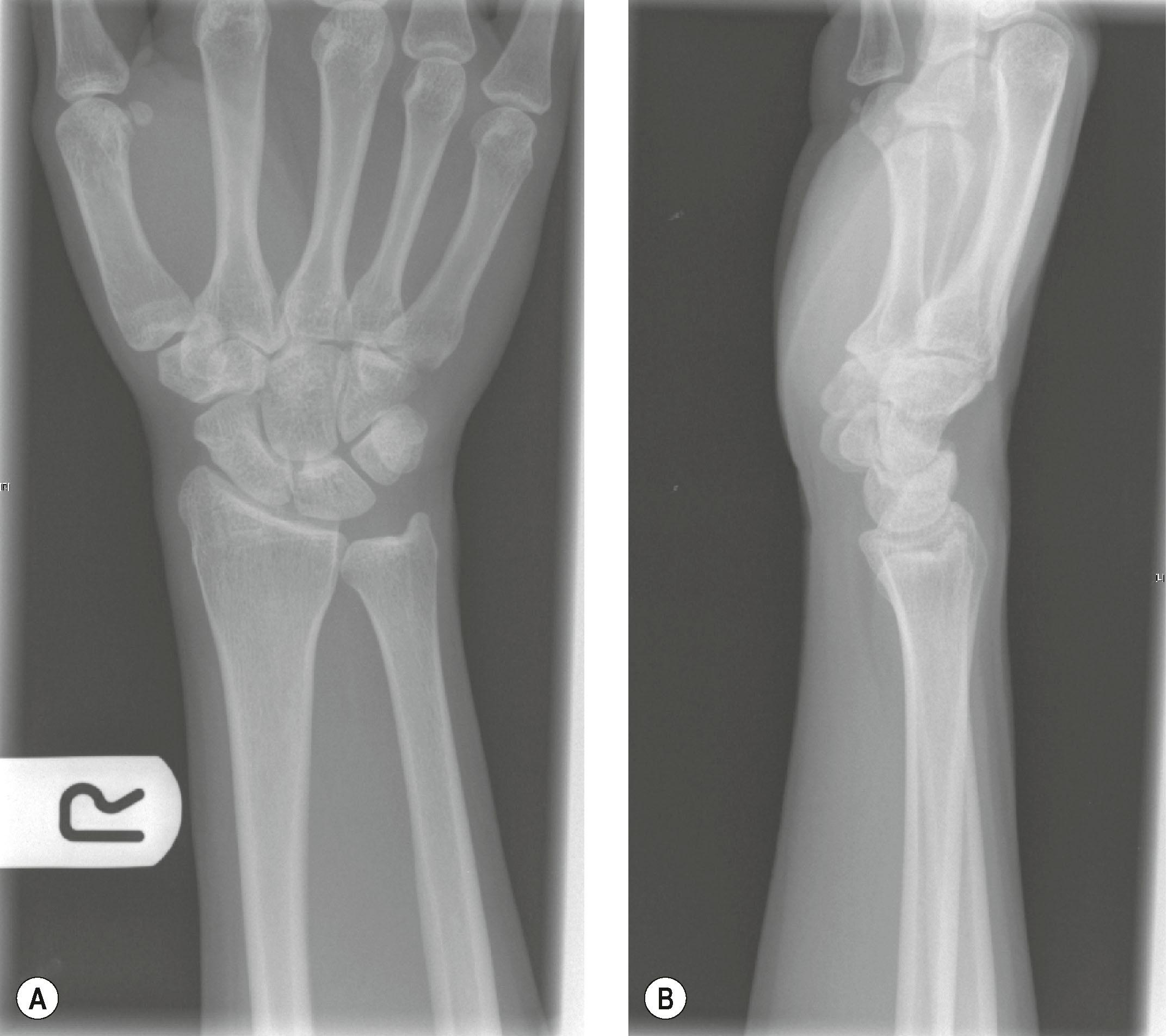 Figure 3.13, Normal wrist radiograph. (A) In the posteroanterior view, note the lateral position of the ulnar styloid and position of the extensor carpi ulnaris groove. It lies radial to the straight line that passes tangential to the radial edge of the ulnar styloid at the fovea. This indicates a good posteroanterior view. (B) On the lateral view, there is good radioulnar overlap.