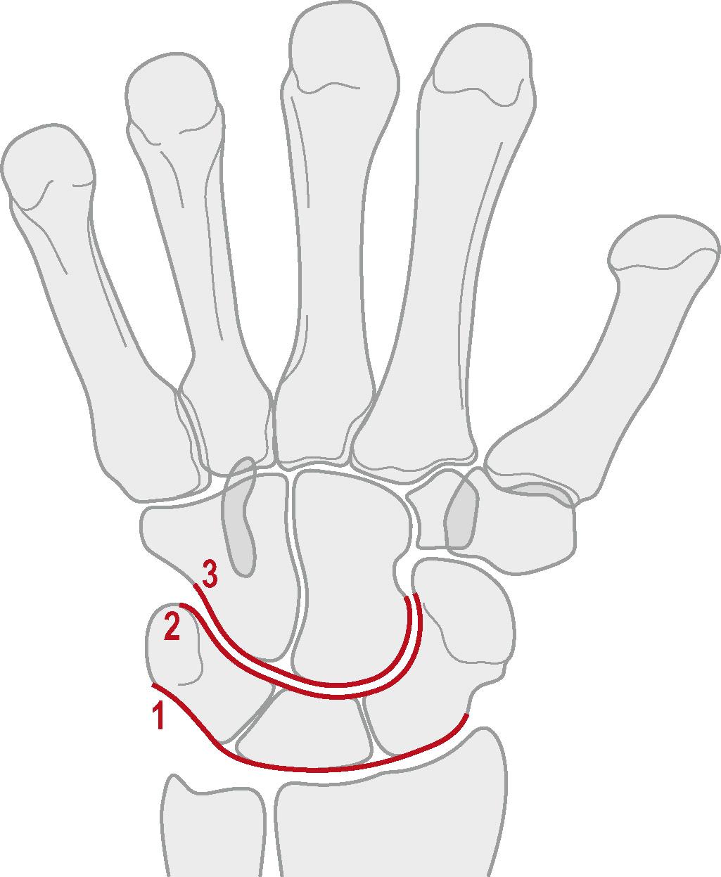 Figure 3.14, In a normal posteroanterior wrist radiograph, three smooth curved non-overlapping lines can be drawn on the proximal and distal cortical surfaces of the proximal carpal bones (lines 1 and 2) and proximal surface of the distal carpal row (line 3). A disruption or step-off indicates a loss of the normal carpal bone relationships.