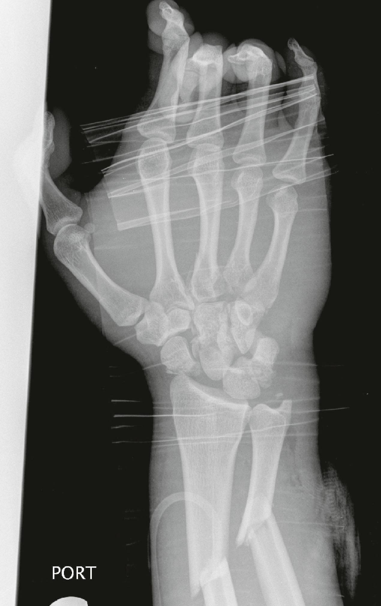 Figure 3.15, This radiograph shows a perilunate fracture dislocation with disruption of the normal smooth carpal arcs. There are associated radioulnar shaft fractures.