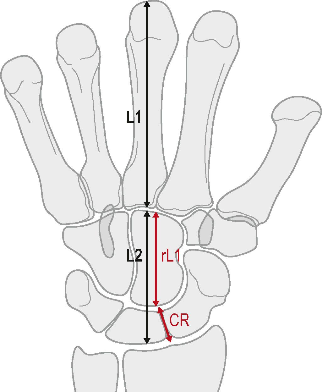 Figure 3.16, (1) Carpal height ratio = carpal height (L2)/third metacarpal length (L1). Normal is 0.54 ± 0.03. (2) Revised carpal height ratio = carpal height (L2)/heights of capitate (rL1). (3) Capitate–radius index (CR). This is the shortest line between two eccentric arches of the carpal rows. The line is moved until the shortest distance is measured. Mean CR index 0.999 ± 0.034. Values less than 0.92 are abnormal.