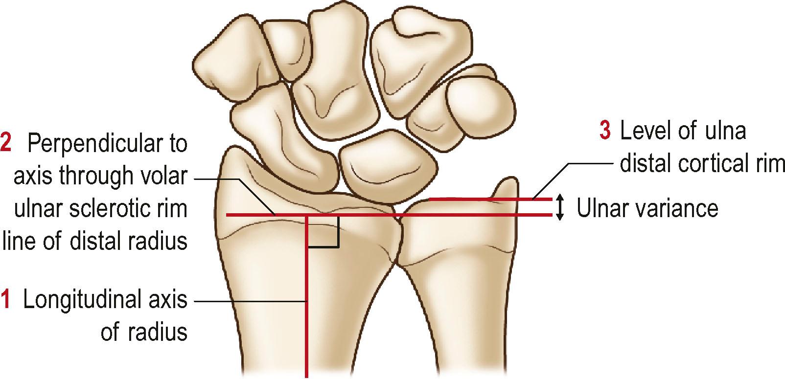 Figure 3.17, Ulnar variance is measured on a true neutral posteroanterior view of the wrist. First (1) a line along the longitudinal axis of the radius is drawn. Next (2) a line perpendicular to this line through the volar ulnar sclerotic rim of the distal radius is drawn. Finally (3) a line parallel to this second line at the level of the distal cortical rim of the ulna is drawn. The distance between these two parallel lines is the ulnar variance.