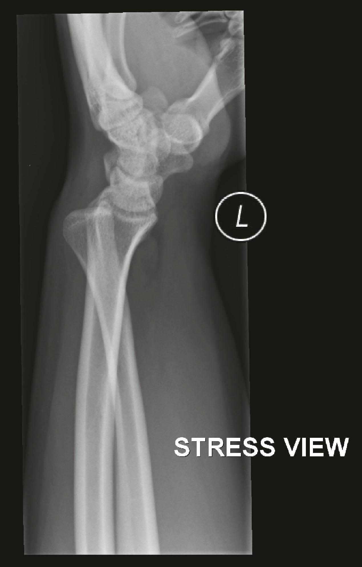 Figure 3.19, Stress view: true lateral of the wrist. Notice the loss of radioulnar overlap due to the dorsal subluxation of the distal radioulnar joint. The pisiform lies between the volar aspect of the scaphoid and capitate, so the view is accurate.