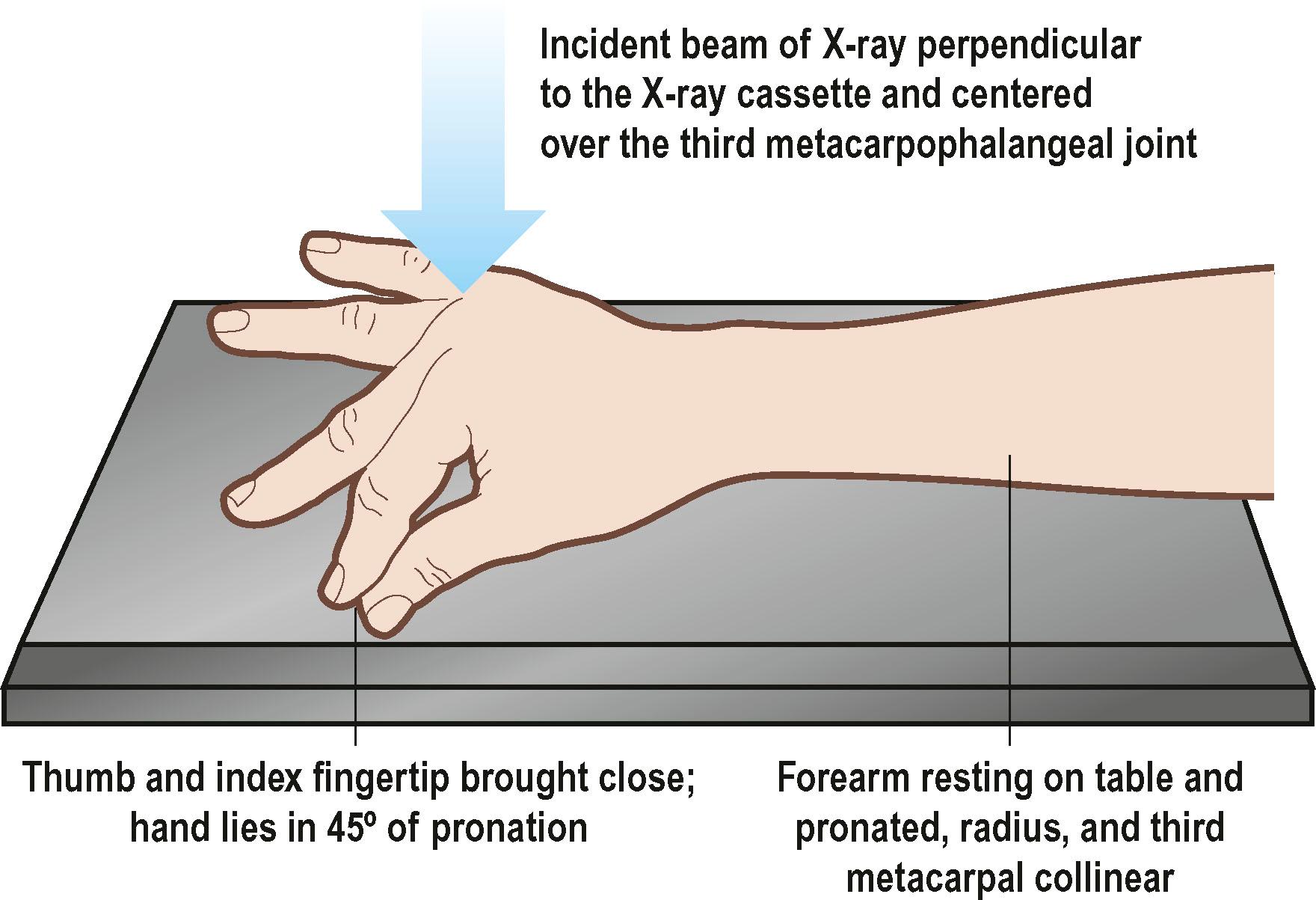 Figure 3.2, The oblique hand radiograph is taken with the hand positioned as shown. This position provides a good non-overlapping view of the metacarpals. The view is not adequate for assessment of the digits; separate lateral views of the digits should be performed if necessary.