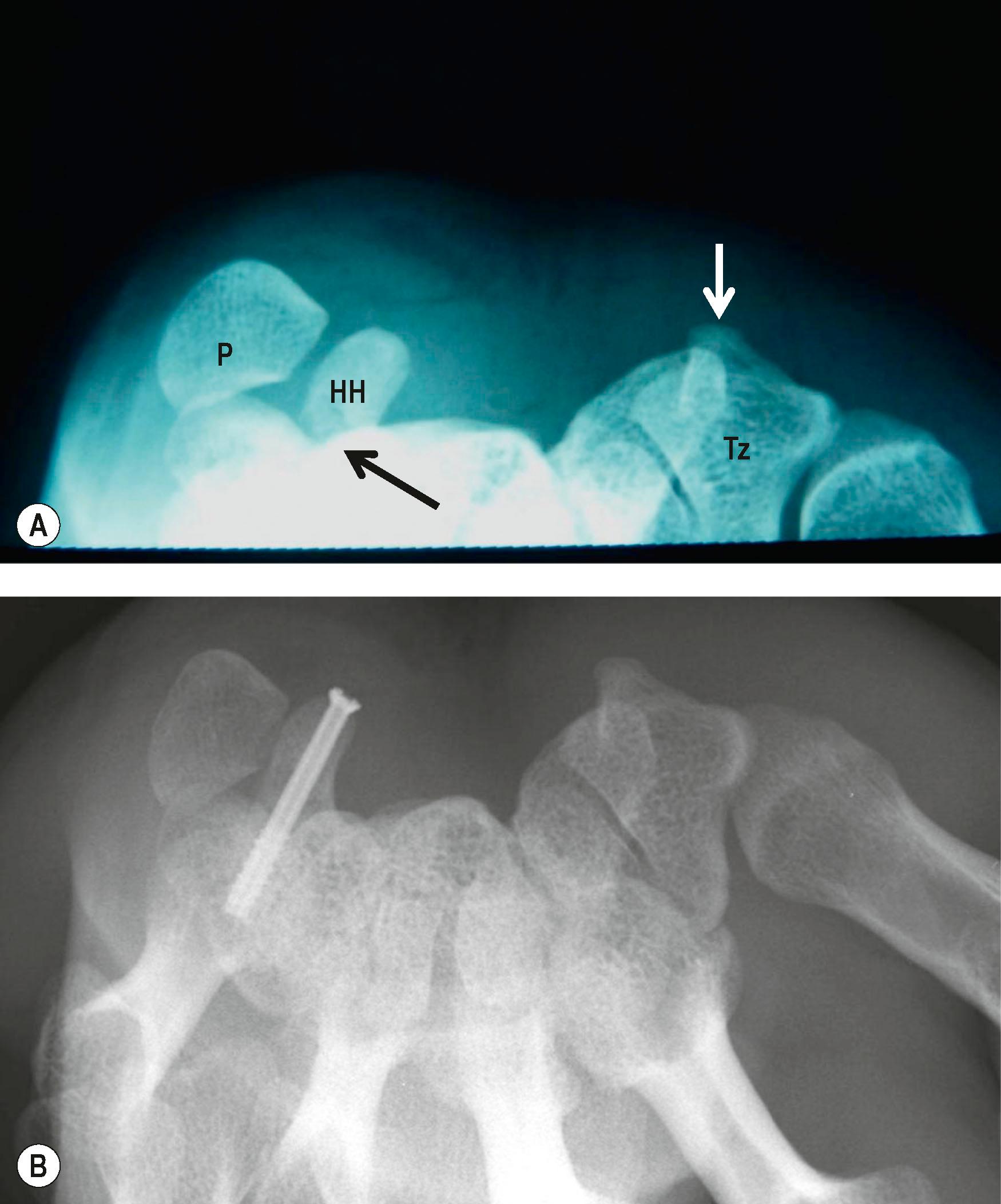 Figure 3.21, (A) Carpal tunnel view of the wrist demonstrating several structures: trapezium (Tz), pisiform (P), and hook of hamate (HH). A fracture across the hook of the hamate is indicated by the black arrow. The trapezial ridge (indicated by white arrow) is an unusual site for fractures that is best seen on this projection. (B) Same patient with carpal tunnel view of the same wrist following open reduction and screw fixation. Notice that the fracture line is no longer visible.