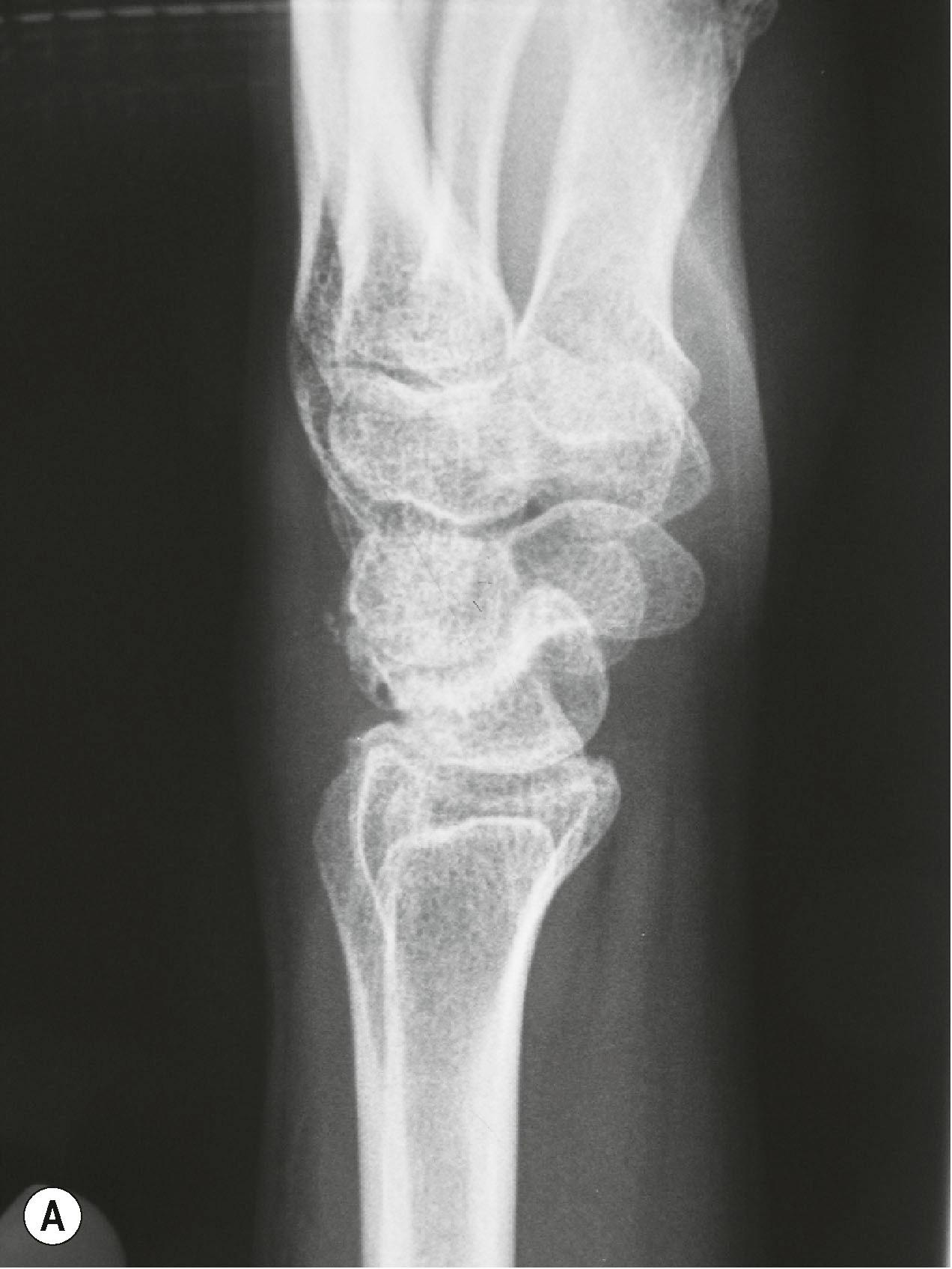 Figure 3.22, DISI is the acronym for dorsal intercalated segmental instability. The term “intercalated segment” refers to the proximal carpal row bones. (A) This row has no direct musculotendinous insertions, hence it is “intercalated”. “Dorsal” refers to the dorsiflexion of the lunate seen in the radiograph. A scapholunate dissociation is the commonest cause of a DISI deformity, and will show an increased scapholunate angle as above. (B) On the posteroanterior view, the scaphoid will appear flexed and foreshortened with a positive cortical ring sign as seen.